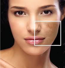 MELASMA TREATMENT