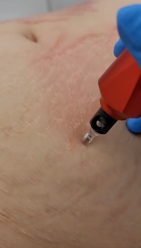 Stretch Marks Removal