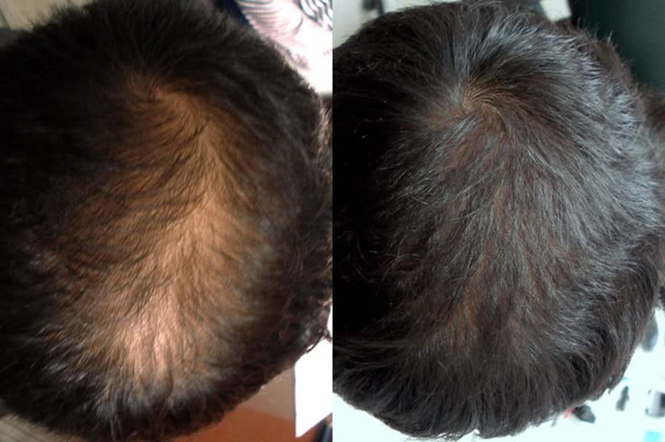 Hair Restoration Treatment