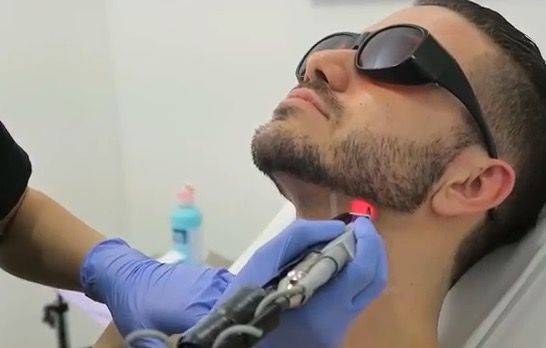 Laser Beard Shaping